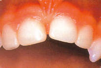  Picture of teeth after performing composite resin restorations. 