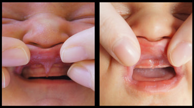 Pictures of a baby's upper lip frenulum, before and after a frenectomy. 