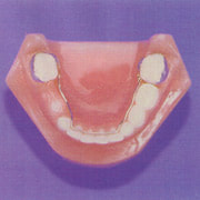 Picture of a lower jaw model showing a lower lingual holding arch.
