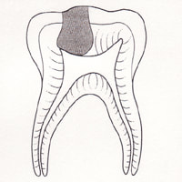 Drawing of a tooth showing the first step of a Pulpotomy.