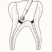 Drawing of a tooth showing the second step of a Pulpotomy.