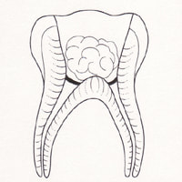 Drawing of a tooth showing the third step of a Pulpotomy.