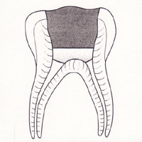 Drawing of a tooth showing the fourth step of a Pulpotomy.