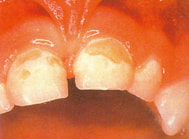 Picture of teeth with decay before performing composite restorations.